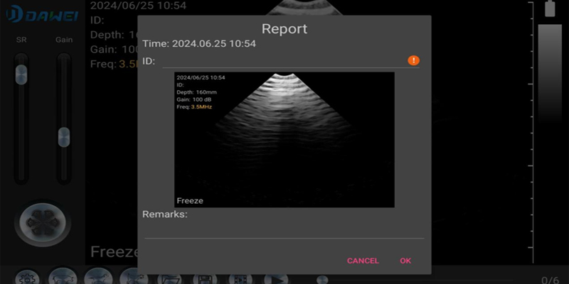 wireless ultrasound probe