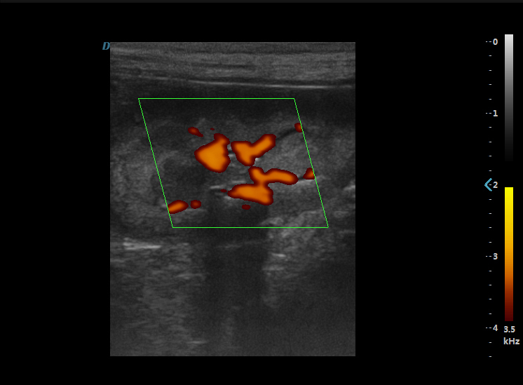 能量多普勒肾脏线阵血流效果图